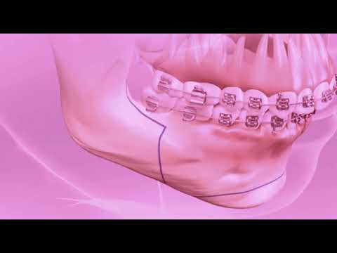 Surgery to reduce prominent teeth