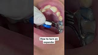 How to turn an RPE (Rapid Palatal Expander) for Orthodontic Treatment 🦷 #braces #expander #ortho