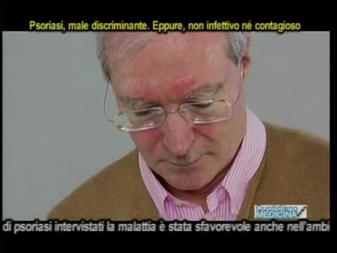 Quali buone creme da eczema Genere di eczema di una fotografia e un trattamento