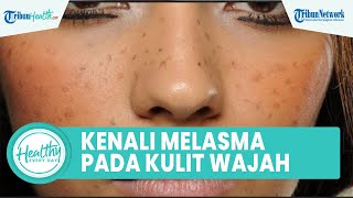 Mengenal Melasma pada Kulit Wajah yang Timbulkan Flek Hitam, Berikut Cara Mengatasinya
