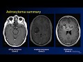 Imaging brain tumors - 2 - Astrocytomas