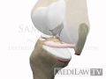 Knee Anterior Cruciate Ligament Rupture Internal ...