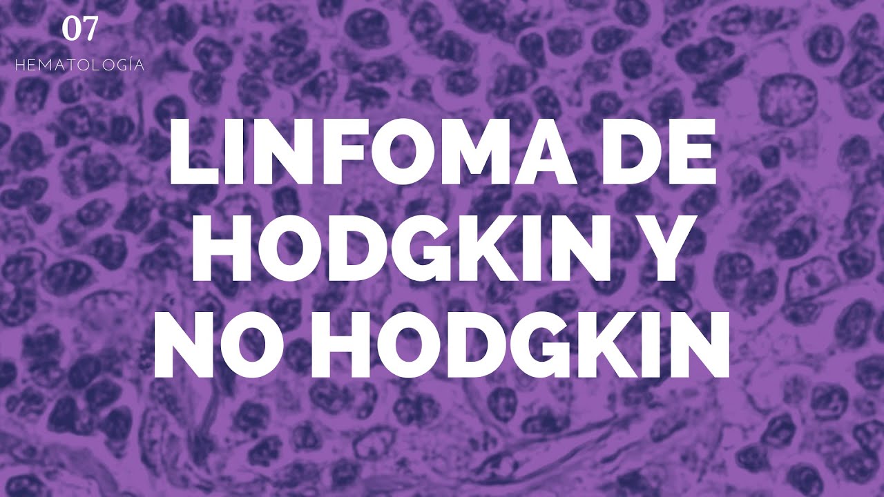 Linfoma de Hodgkin y no Hodgkin - ENARM
