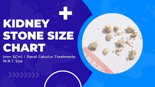 Kidney Stone Size Chart (mm &Cm) | Renal Calculus Treatments W.R.T. Size
