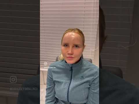 Revision Rhinoplasty in Antalya, Turkey | Extreme Case | Assoc. Prof. Dr. Hüseyin Balıkçı