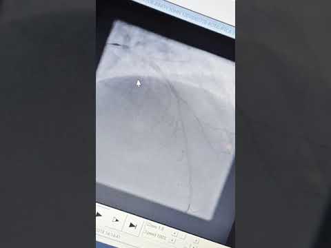 Rotablation angioplasty in High-Bleeding Risk (HBR) patients. Dr Binoy John