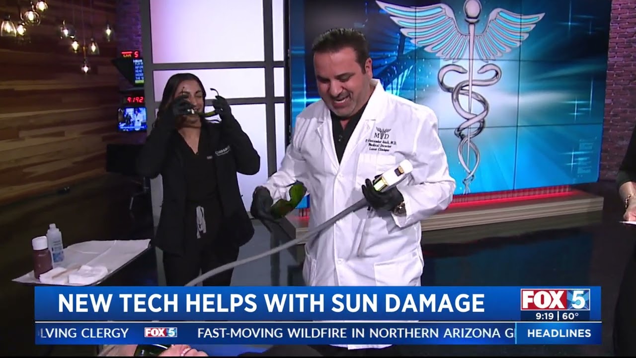 BBL Hero Laser for Sun Damaged Skin as seen on Fox 5 San Diego News