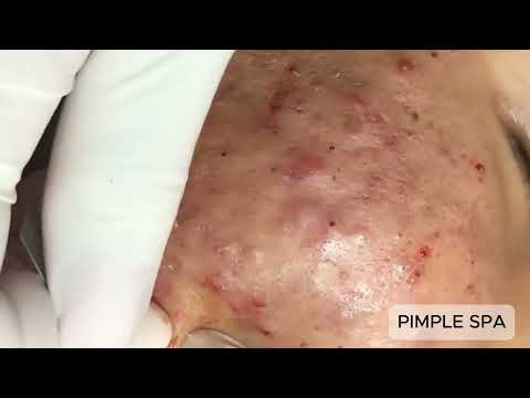 Satisfying Face Pimple Popping in Real Time – Massive Acne Removal Compilation Part 1