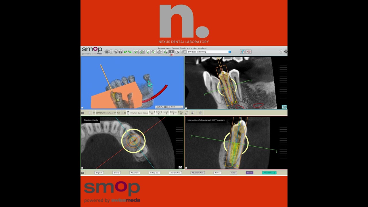 What to do after receiving the setup design from nexus dental in SMOP