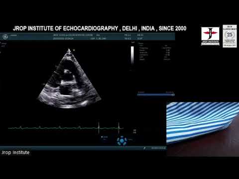 52th 6th Session  Live Demonstration , M Mode,2D echo &Color Doppler & measurement.