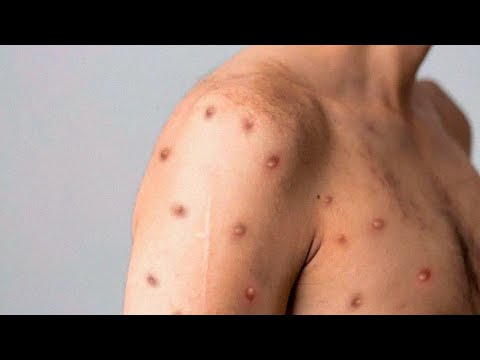 Hasta el momento no se notificaron casos sospechosos de viruela símica en Salta