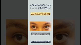 Surgery process for a lazy eye