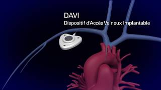 Cathéter à chambre implantable (DAVI)