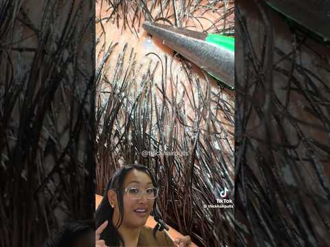 multiple hairs stuck in one pore. #reaction #hairremoval #ingrownhairremoval #wax