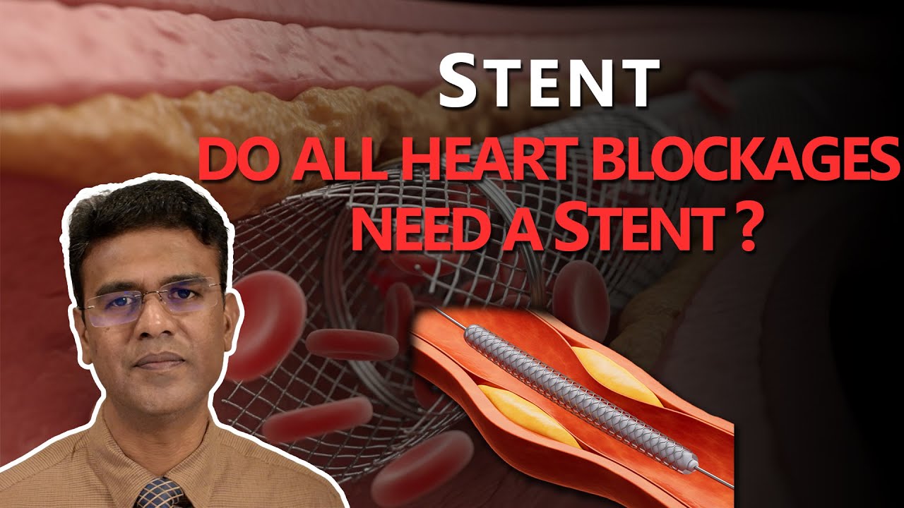 Do All Heart Blockages Need a Stent?