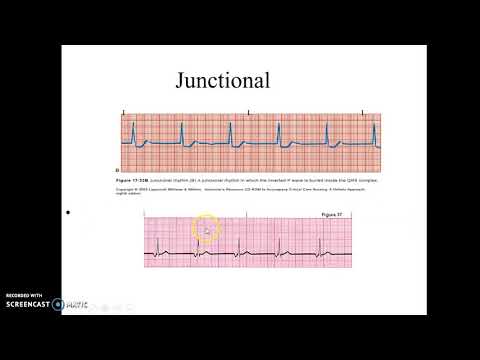 Junctional Rhythms