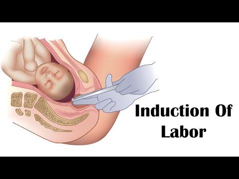 Einleitung der Wehen - Künstlicher Blasensprung (Amniotomie) -