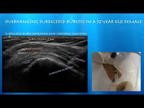 Ultrasound guided Subacromial Injection of an Overhanding Subdeltoid Bursisitis, probeultrasound.com