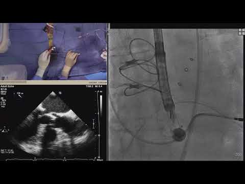LIVE CASE 3  SAPIEN 3 TAVR with Difficult Vascular Access
