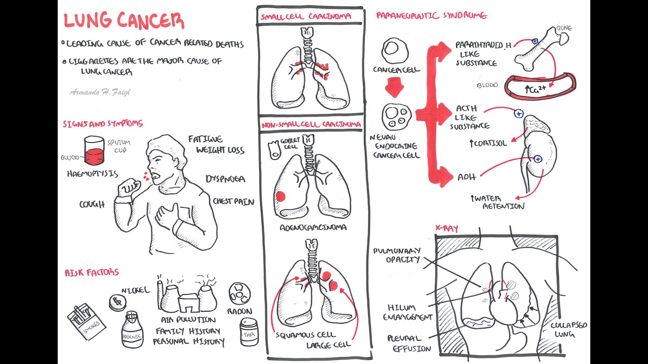 Lung Cancer - Overview