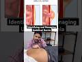 Identifying And Managing Umbilical Hernia Ytshort Feed Trend Feedshort