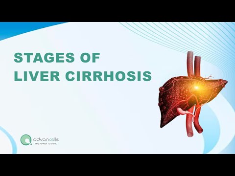 Are You at Risk? 4 Stages of Liver Cirrhosis Explained | #LiverDisease