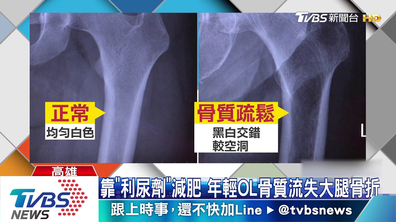 靠「利尿劑」減肥 年輕OL骨質流失大腿骨折
