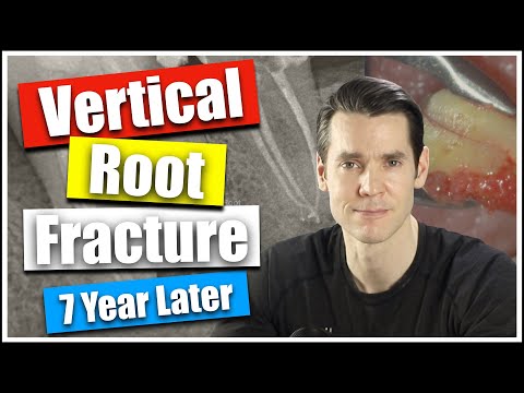 Vertical Root Fracture Diagnosed 7 Years Later