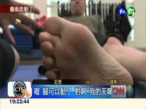 脊椎植電極片 電刺激癱瘓竟能走