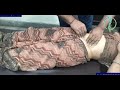 Navel Gas Acidity Treatment Saree Woman Gas Acidity Chiropracticadjustment Chiropractor