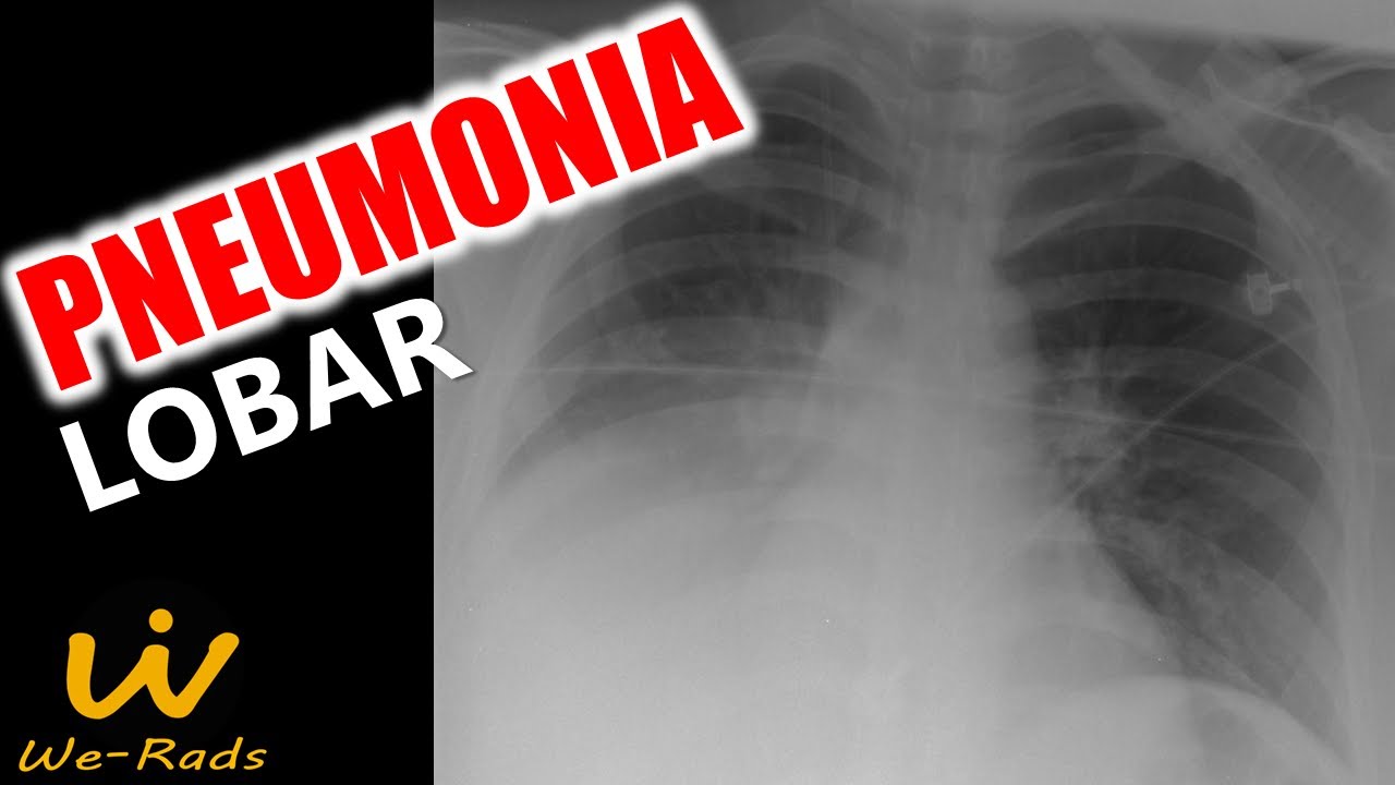 Pneumonia Lobar no Raio-X e na Tomografia Computadorizada de Tórax