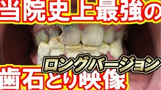[問卦] 牙結石是不是造物者偉大的發明