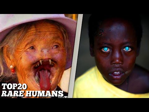 Top 20 rare humans that are one in millions!!