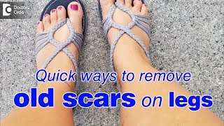 How to remove old scars on legs fast? - Dr. Rasya Dixit