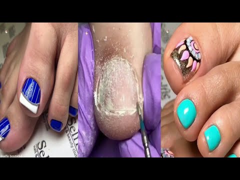 Most Amazing Ugly Toenails Transformation Awesome Pedicure Tutorial #13