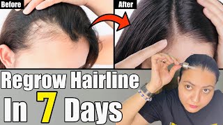7 Days Challenge : Regrow Lost Hairline, Bald Patches & Get Longer, Thicker and Faster Hair Growth