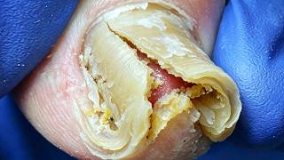 Toenails Grow Into Arch Bridges!😲 Professional Pedicure Process【Xue Yidao】
