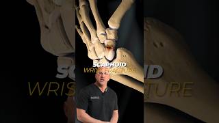 Small Bone, BIG Wrist Problems #shorts