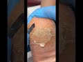 Heel Callus Removal