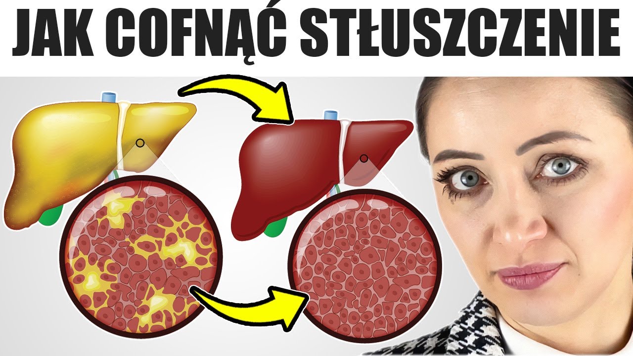 Dzięki temu cofniesz stłuszczenie wątroby
