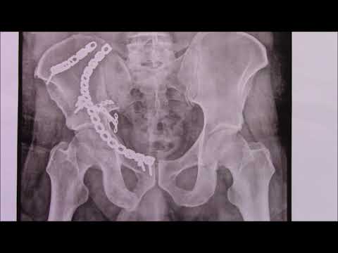 QUADRIL FRATURA PÉLVICA do ACETÁBULO FISIOTERAPIA RECUPERAÇÃO PÓS OPERATÓRIO Clínica Dr Robson Sitta