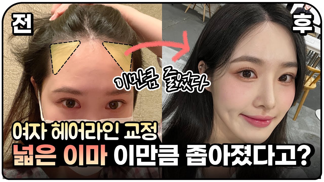 넓은이마가 이만큼 좁아지네요! 이마축소? 헤어라인교정?ㅣ1600모낭ㅣ뉴헤어