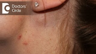 Causes of painful lymph nodes in neck - Dr. Satish Babu K