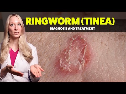 Ringworm (Tinea) - Diagnosis, Treatments, and Home Tips from a Dermatologist