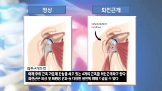 [기획취재] 어깨 통증, 오십견과 회전근개파열