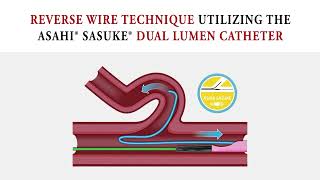 Dual-Lumen Catheterization: Utilizing the Reverse Wire Method