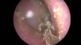 215 - Dead INFECTED Skin, Ear Wax and Fluid Removed off Eardrum - Mr Neel Raithatha (THC)