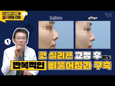실제 사례로 보는 "내가 코 실리콘 보형물을 싫어하는 이유" #4 #코삐뚤어짐 #실리콘이동술 #코보형물제거