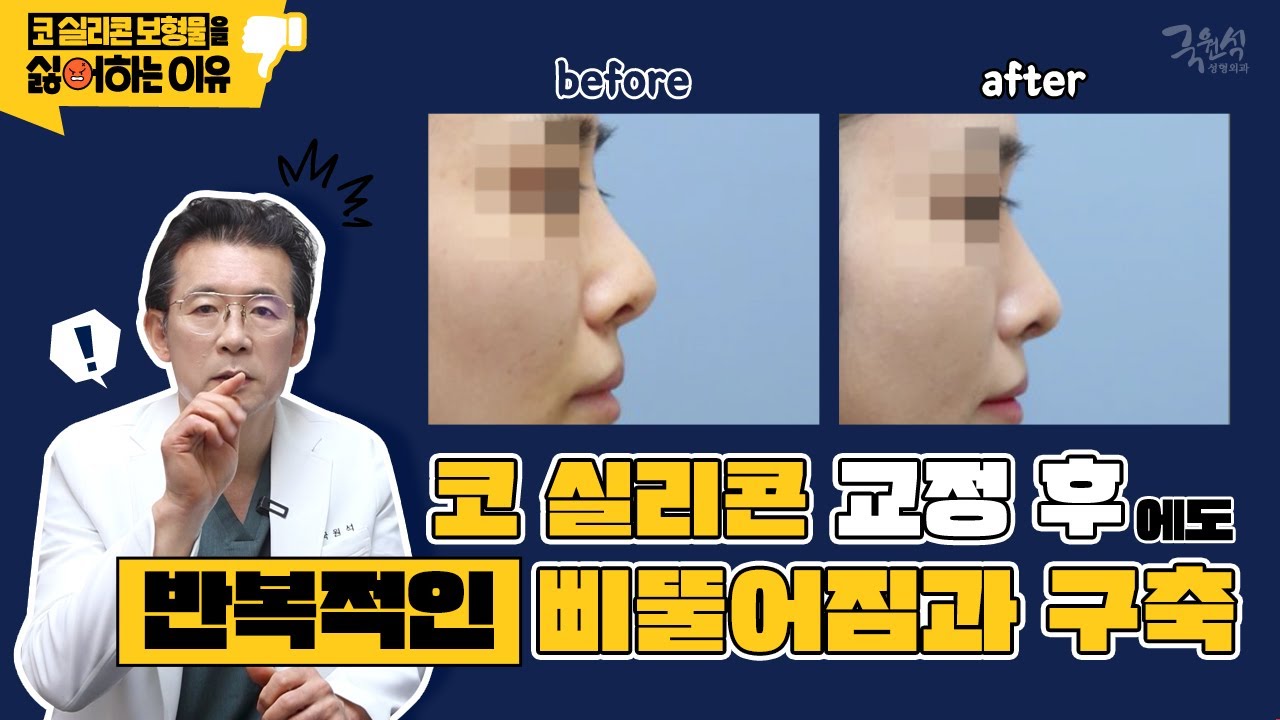 실제 사례로 보는 "내가 코 실리콘 보형물을 싫어하는 이유" #4 #코삐뚤어짐 #실리콘이동술 #코보형물제거 썸네일