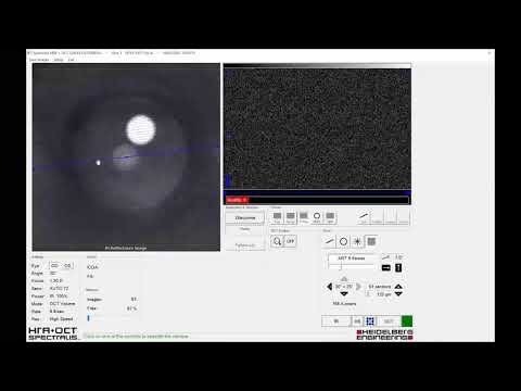 SPECTRALIS OCT LIVE Virtual Workshop - Glaucoma